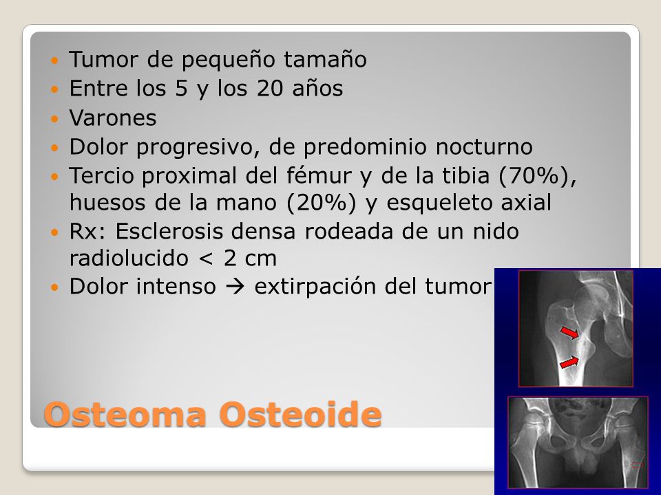 Osteoma Osteoide Tumor de pequeño tamaño Entre los 5 y los 20 años