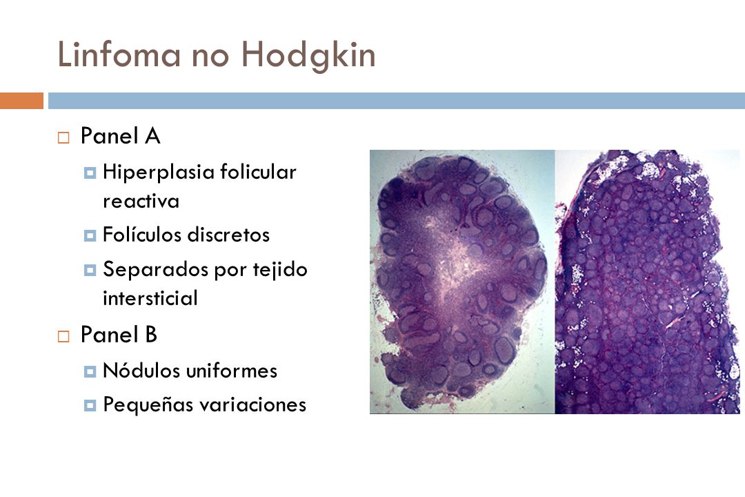 Linfoma no Hodgkin Panel A Panel B Hiperplasia folicular reactiva