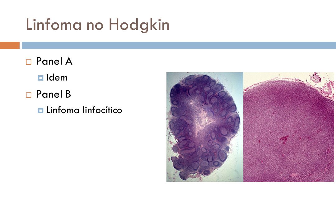 Linfoma no Hodgkin Panel A Idem Panel B Linfoma linfocítico