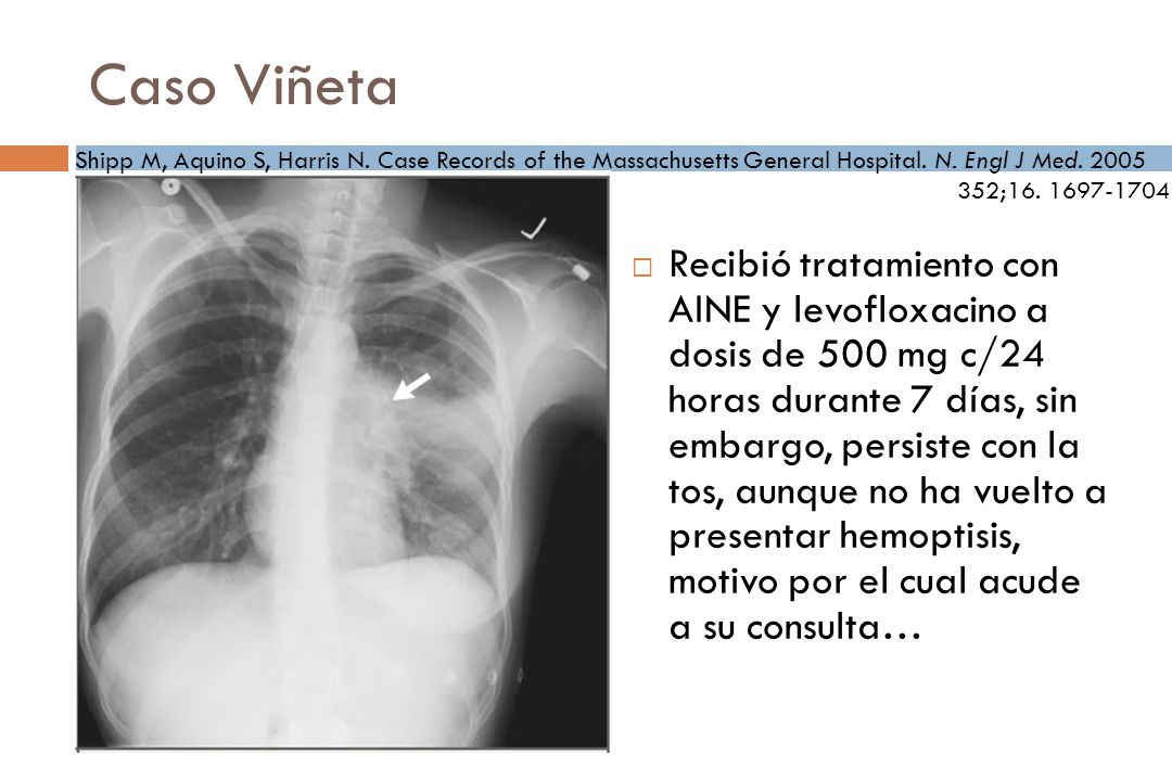 Caso Viñeta Shipp M, Aquino S, Harris N. Case Records of the Massachusetts General Hospital. N. Engl J Med