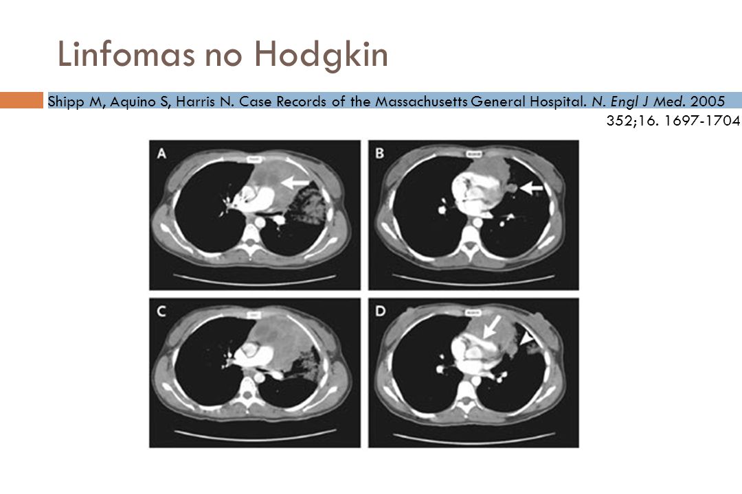 Linfomas no Hodgkin Shipp M, Aquino S, Harris N. Case Records of the Massachusetts General Hospital. N. Engl J Med