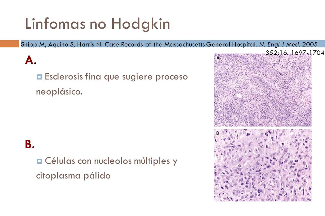 Linfomas no Hodgkin A. B. Esclerosis fina que sugiere proceso