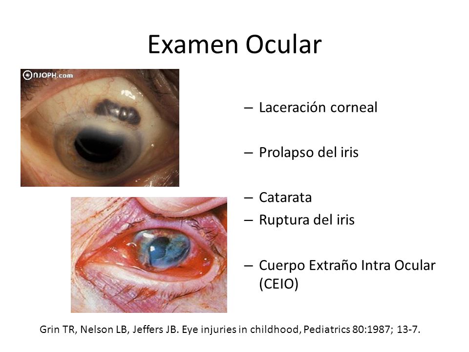 Examen Ocular Laceración corneal Prolapso del iris Catarata
