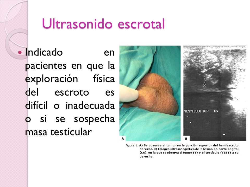 Ultrasonido escrotal Indicado en pacientes en que la exploración física del escroto es difícil o inadecuada o si se sospecha masa testicular.