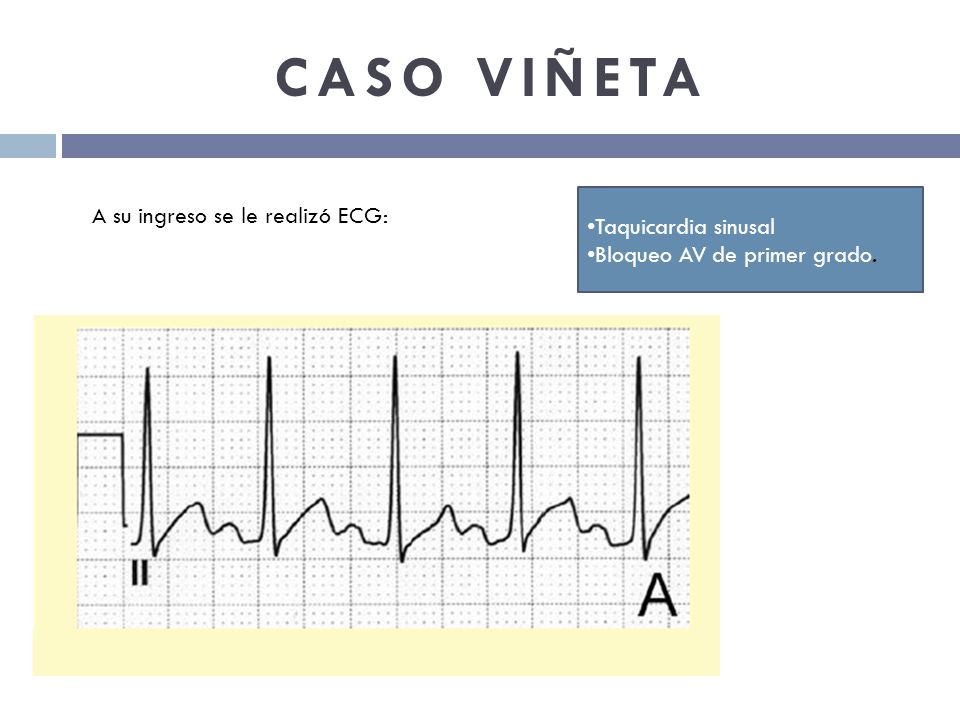 CASO VIÑETA A su ingreso se le realizó ECG: Taquicardia sinusal