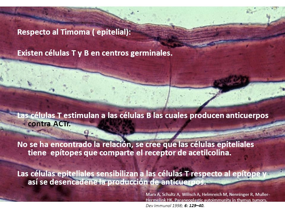 Respecto al Timoma ( epitelial): Existen células T y B en centros germinales. Las células T estimulan a las células B las cuales producen anticuerpos contra ACTr. No se ha encontrado la relación, se cree que las células epiteliales tiene epítopes que comparte el receptor de acetilcolina. Las células epiteliales sensibilizan a las células T respecto al epítope y así se desencadene la producción de anticuerpos.