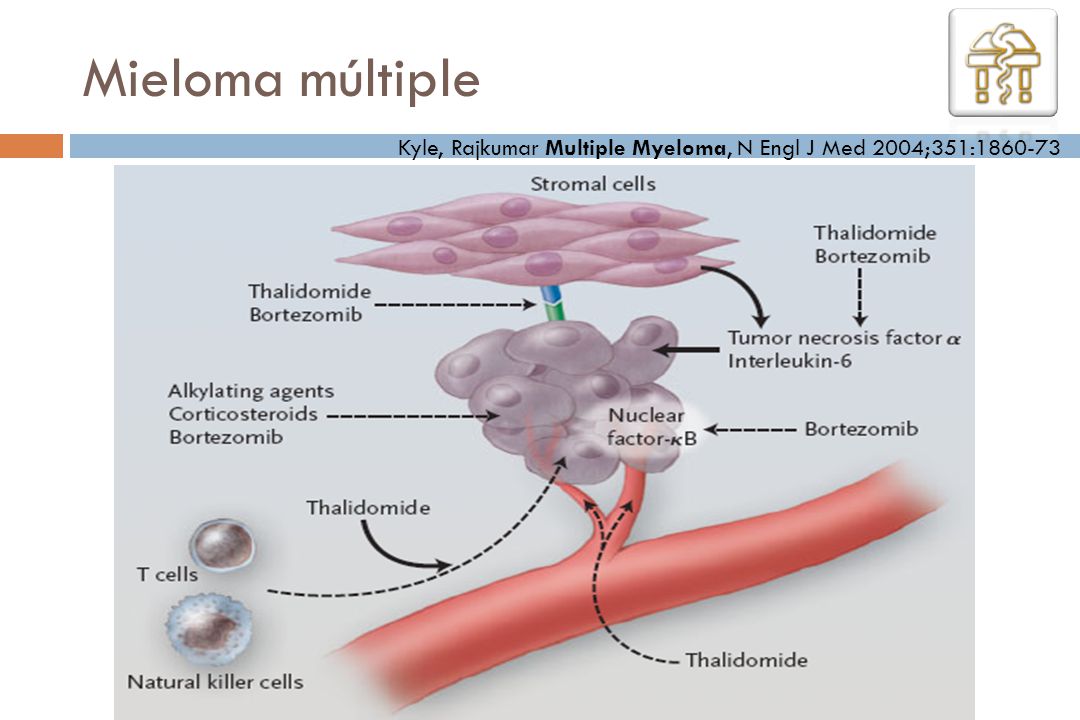 Mieloma múltiple Kyle, Rajkumar Multiple Myeloma, N Engl J Med 2004;351: