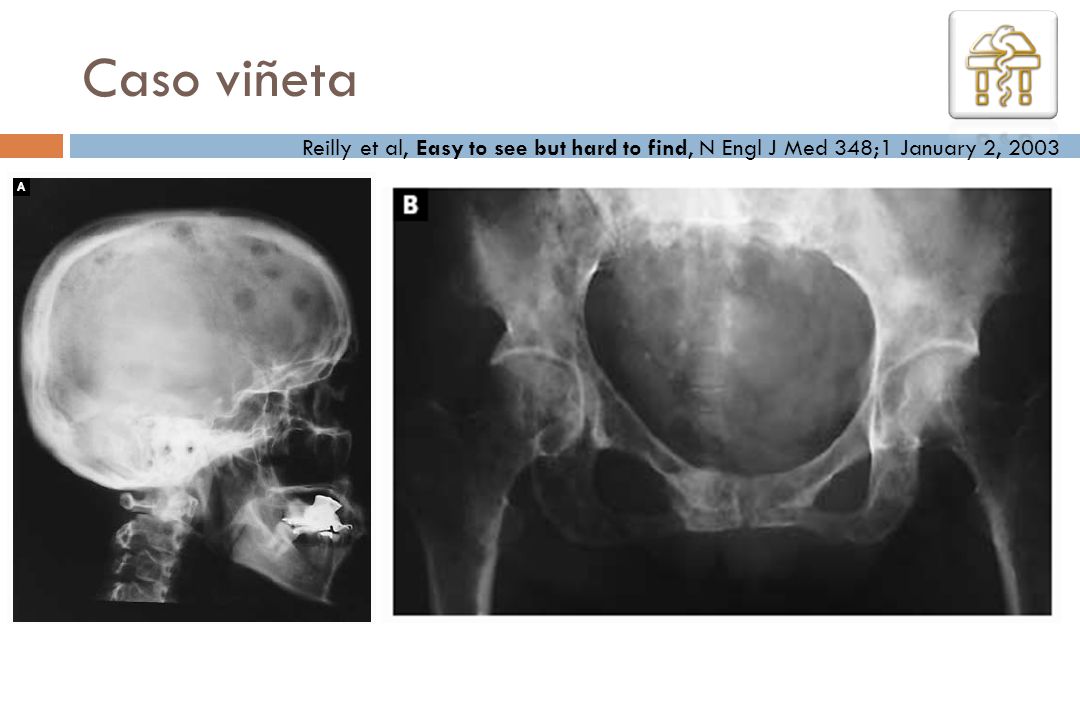 Caso viñeta Reilly et al, Easy to see but hard to find, N Engl J Med 348;1 January 2, 2003