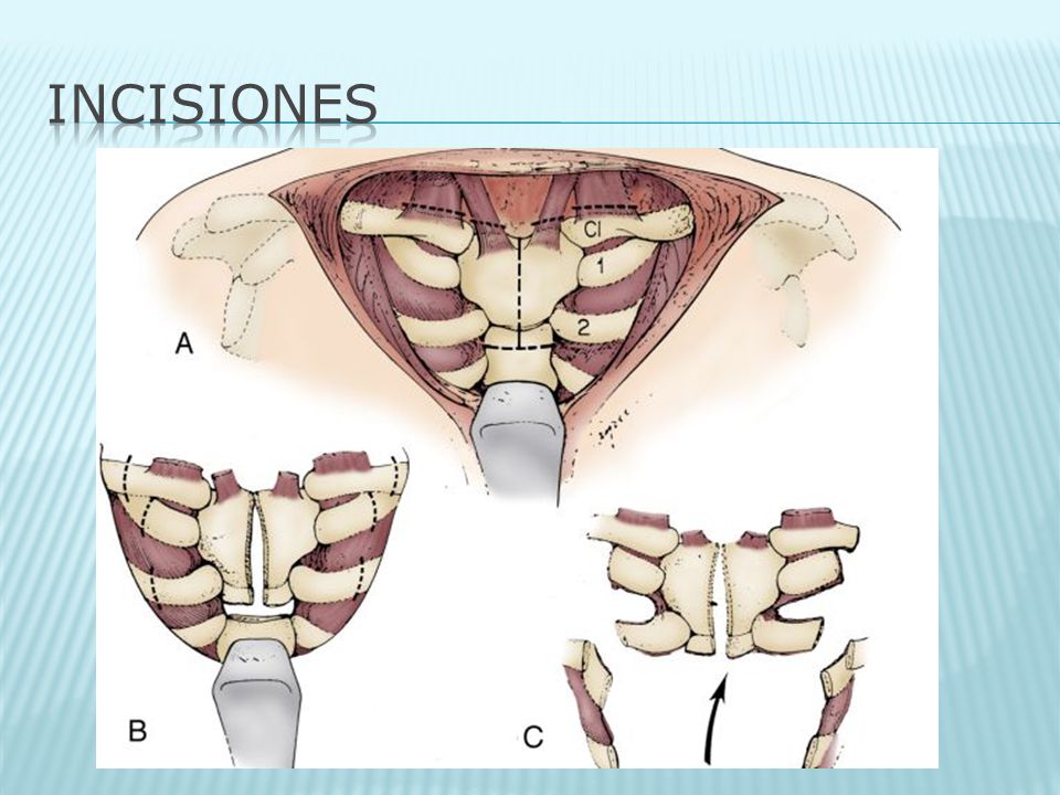 INCISIONES