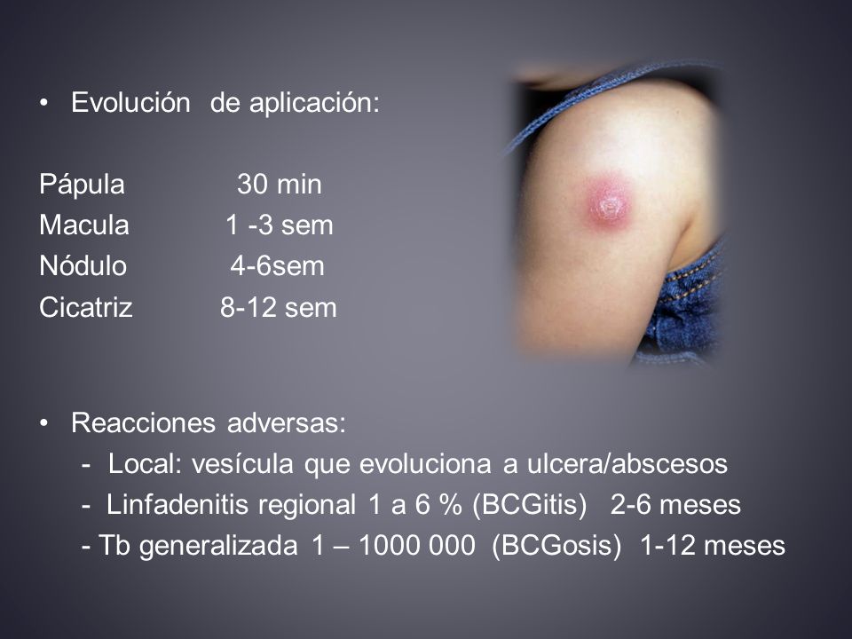 Evolución de aplicación: Pápula 30 min Macula 1 -3 sem Nódulo 4-6sem