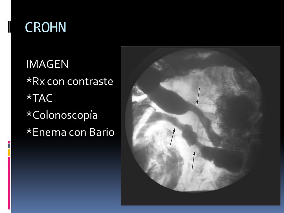 CROHN IMAGEN *Rx con contraste *TAC *Colonoscopía *Enema con Bario