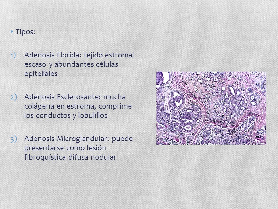 Tipos: Adenosis Florida: tejido estromal escaso y abundantes células epiteliales.