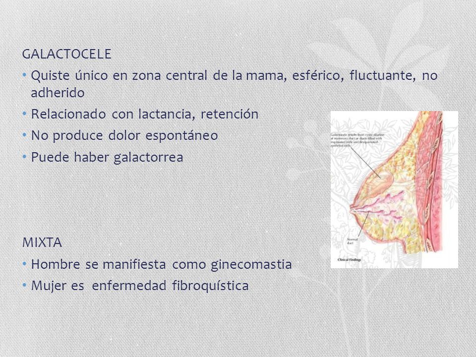 GALACTOCELE Quiste único en zona central de la mama, esférico, fluctuante, no adherido. Relacionado con lactancia, retención.