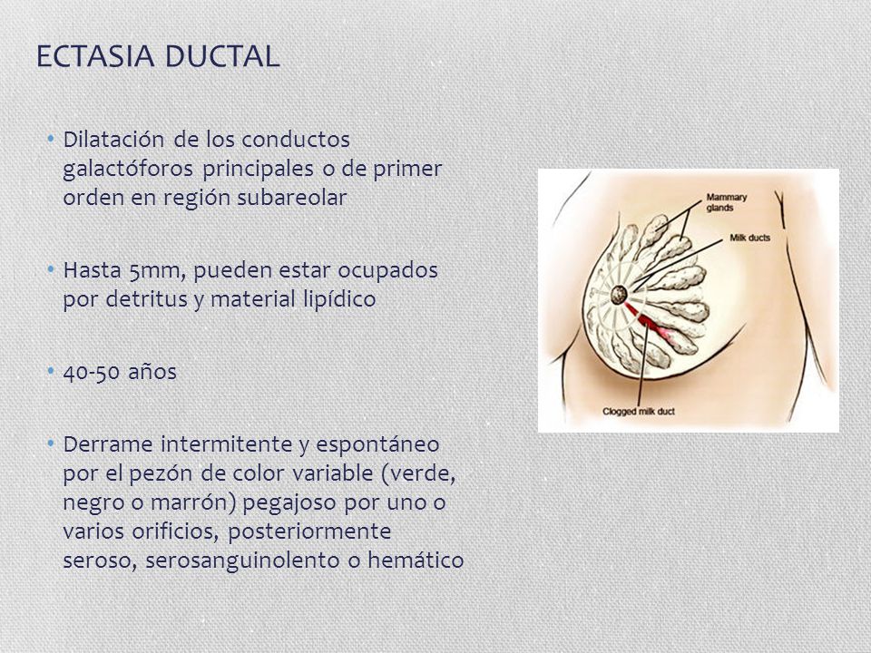 ECTASIA DUCTAL Dilatación de los conductos galactóforos principales o de primer orden en región subareolar.