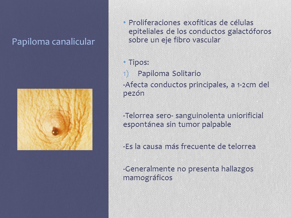 Papiloma canalicular Proliferaciones exofíticas de células epiteliales de los conductos galactóforos sobre un eje fibro vascular.
