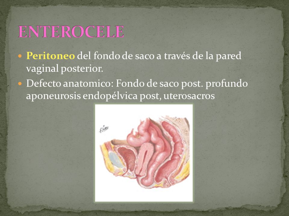 ENTEROCELE Peritoneo del fondo de saco a través de la pared vaginal posterior.