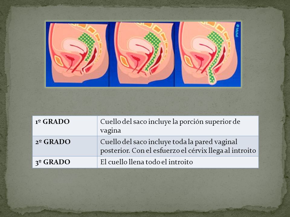 1º GRADO Cuello del saco incluye la porción superior de vagina. 2º GRADO.