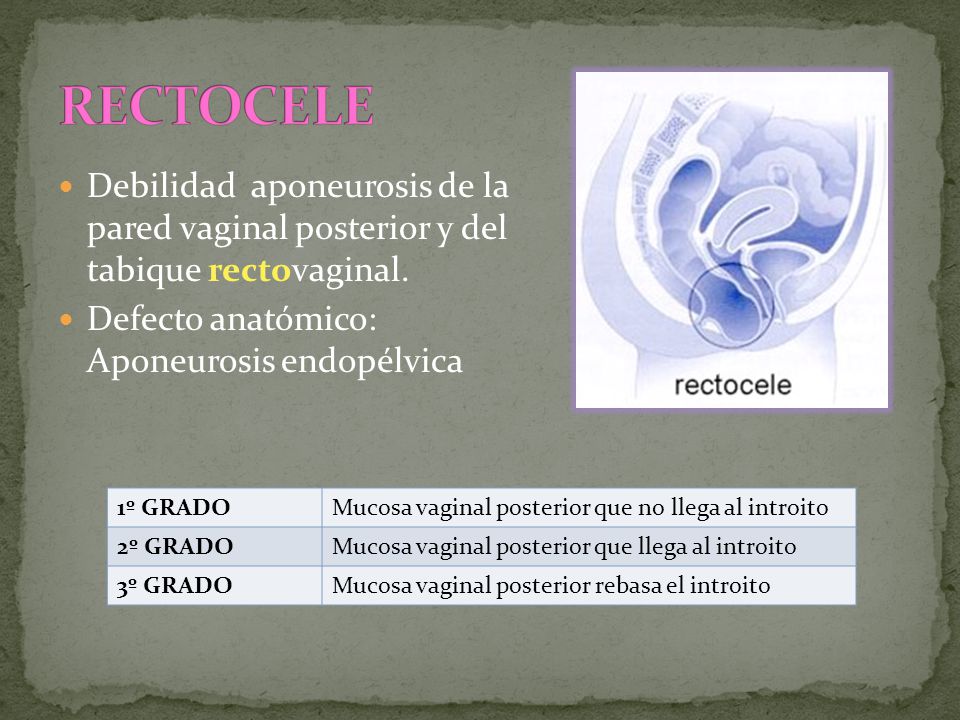 RECTOCELE Debilidad aponeurosis de la pared vaginal posterior y del tabique rectovaginal. Defecto anatómico: Aponeurosis endopélvica.