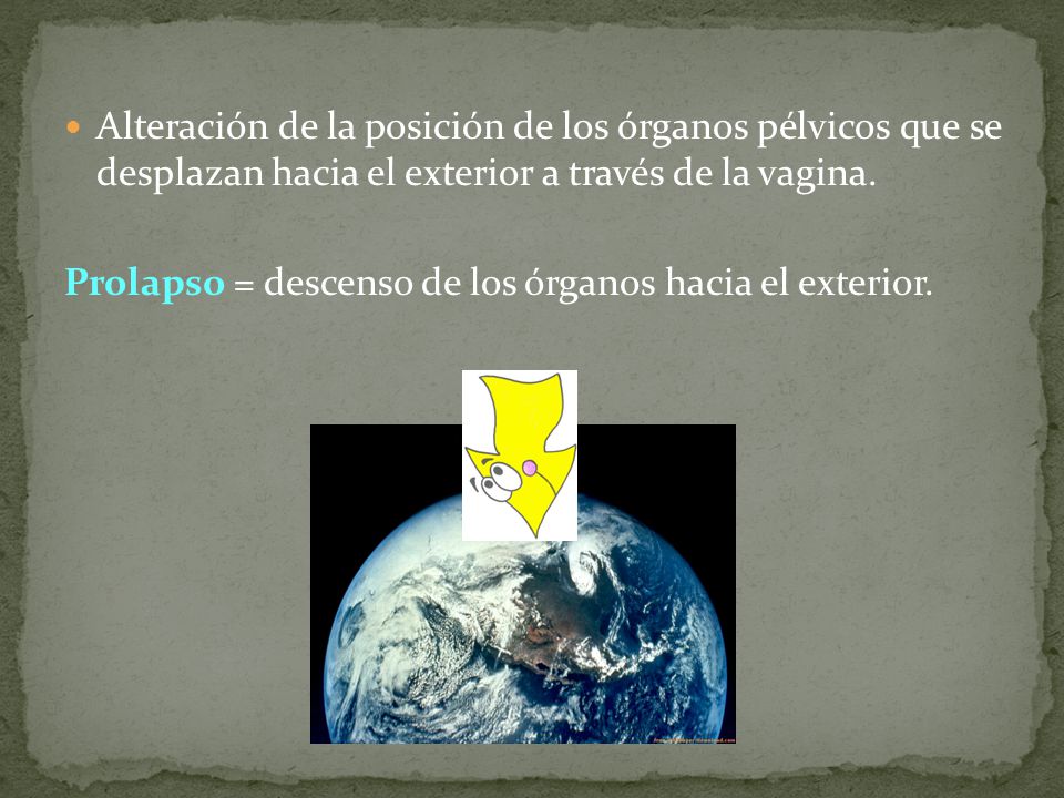 Alteración de la posición de los órganos pélvicos que se desplazan hacia el exterior a través de la vagina.