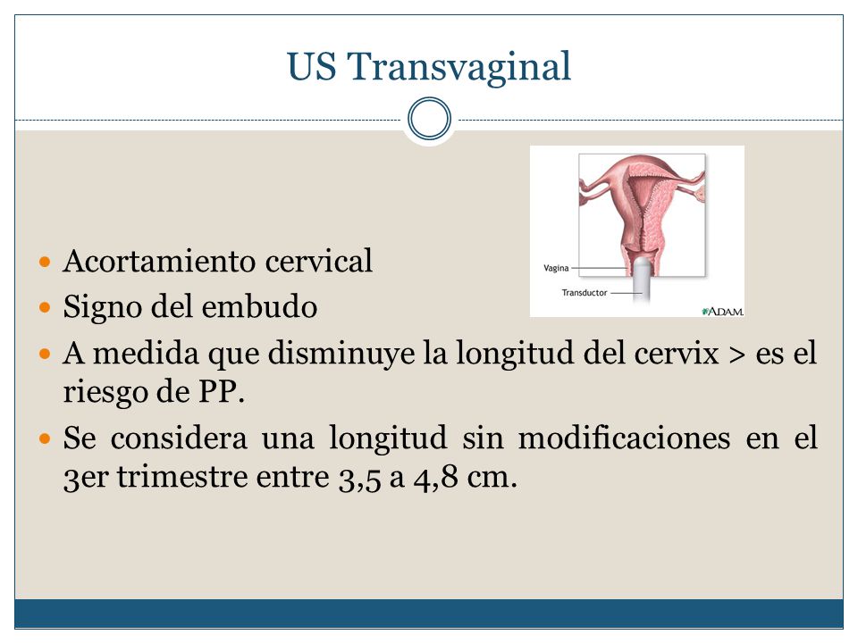 US Transvaginal Acortamiento cervical Signo del embudo