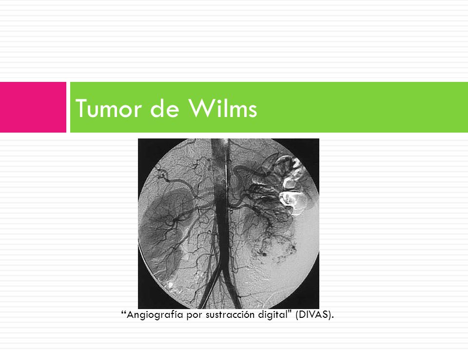 Tumor de Wilms Angiografía por sustracción digital (DIVAS).