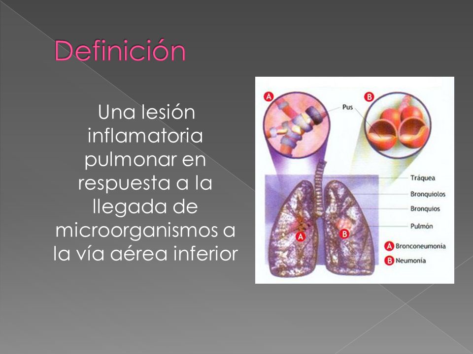 Definición Una lesión inflamatoria pulmonar en respuesta a la llegada de microorganismos a la vía aérea inferior.