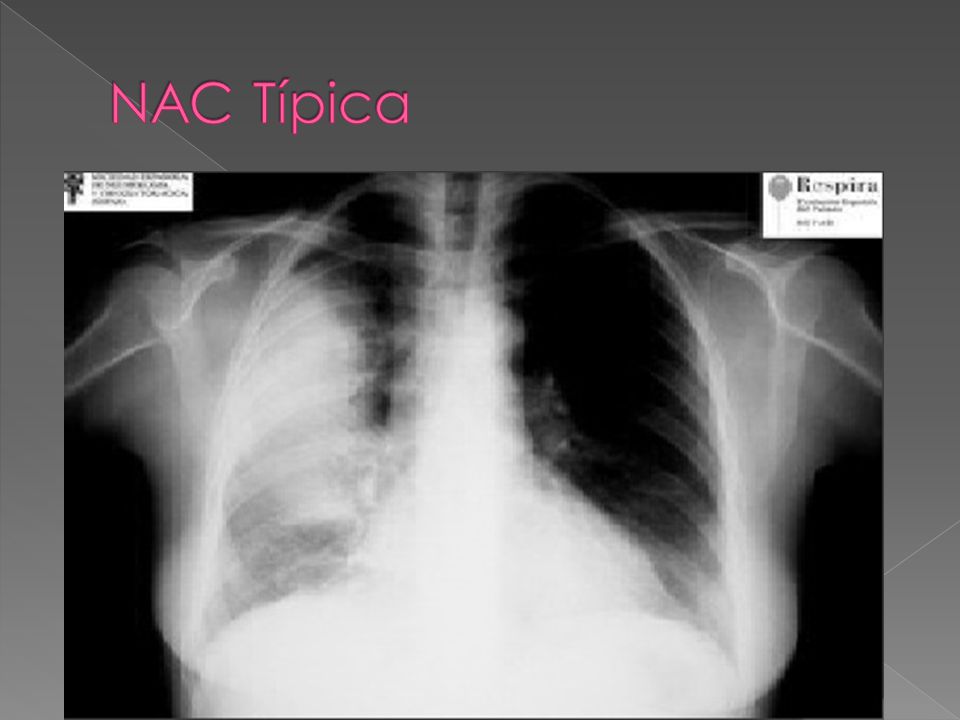 NAC Típica Cuadro súbito Fiebre alta Dolor pleurítico Tos