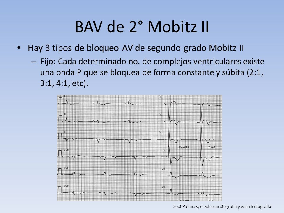 BAV de 2° Mobitz II Hay 3 tipos de bloqueo AV de segundo grado Mobitz II.