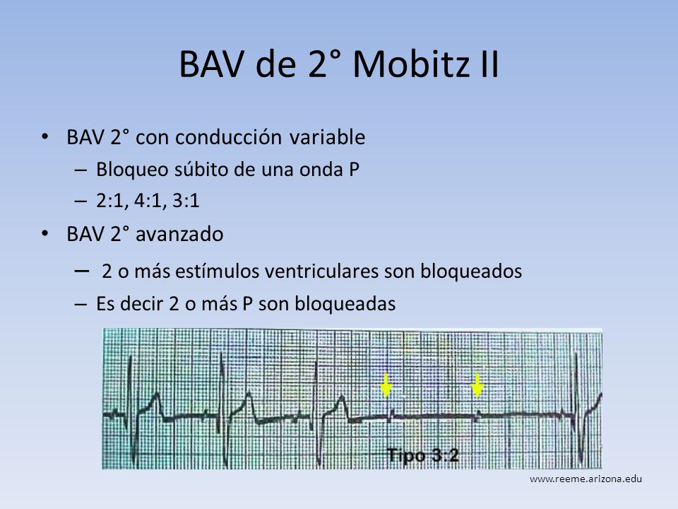 BAV de 2° Mobitz II 2 o más estímulos ventriculares son bloqueados