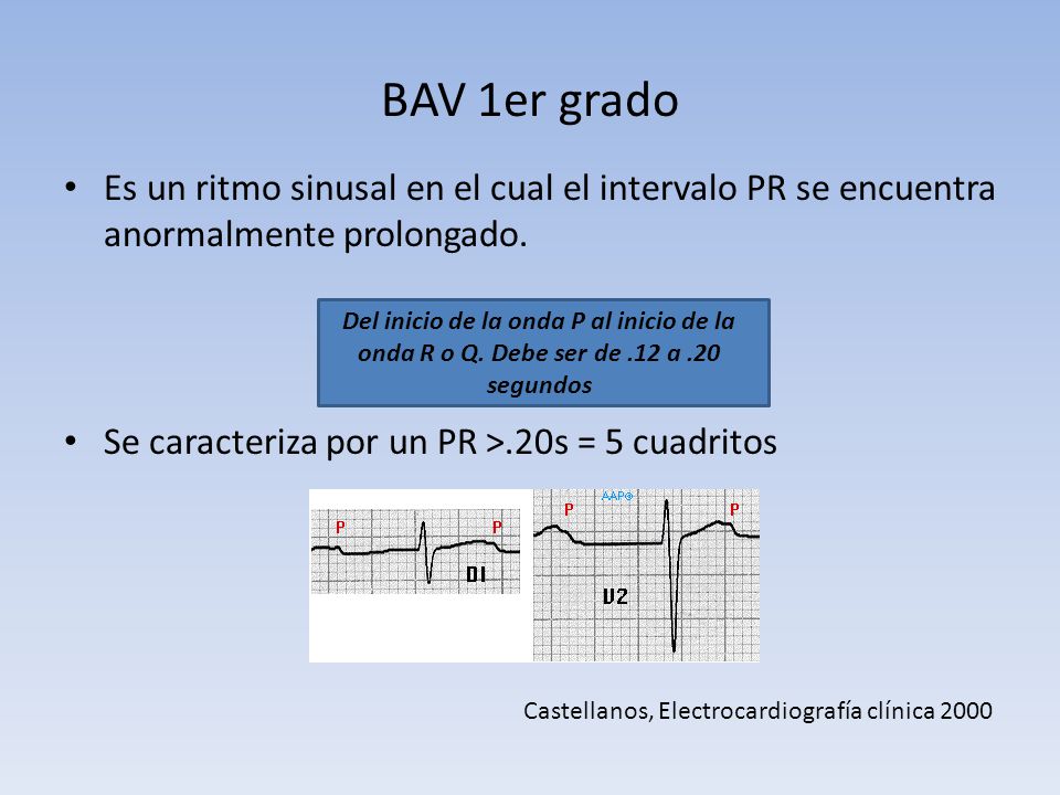 BAV 1er grado Es un ritmo sinusal en el cual el intervalo PR se encuentra anormalmente prolongado. Se caracteriza por un PR ˃.20s = 5 cuadritos.