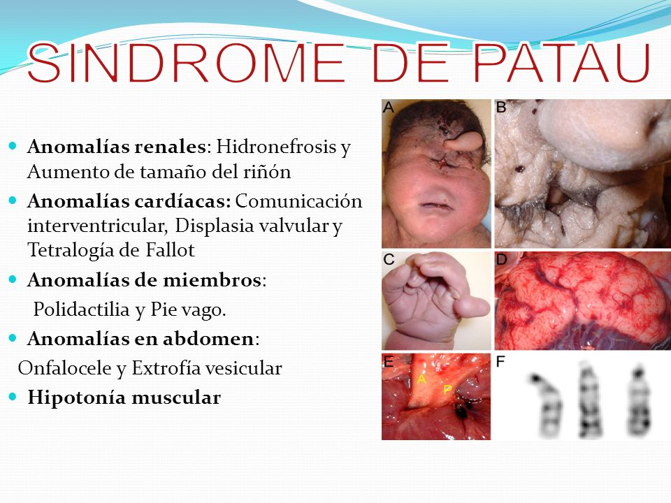 SINDROME DE PATAU Anomalías renales: Hidronefrosis y Aumento de tamaño del riñón.