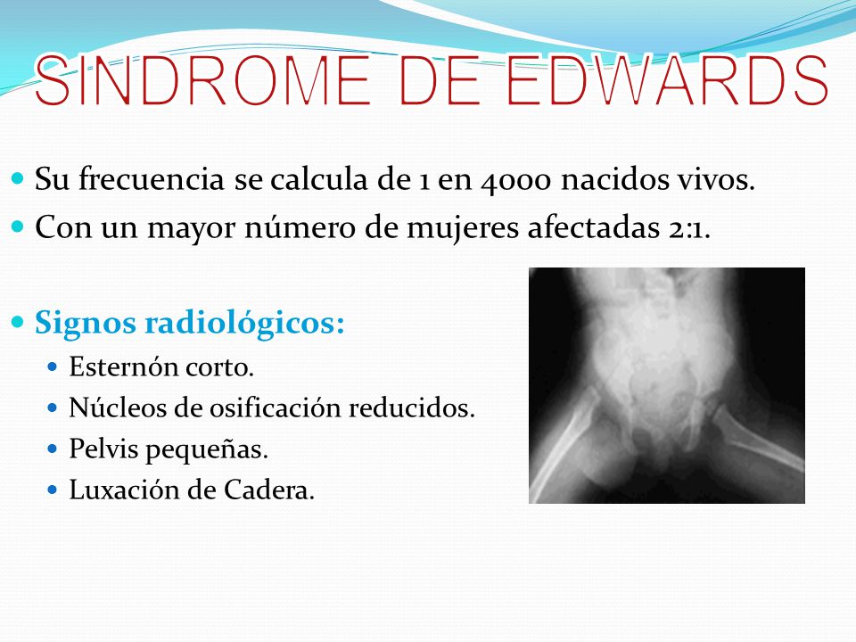 SINDROME DE EDWARDS Su frecuencia se calcula de 1 en 4000 nacidos vivos. Con un mayor número de mujeres afectadas 2:1.