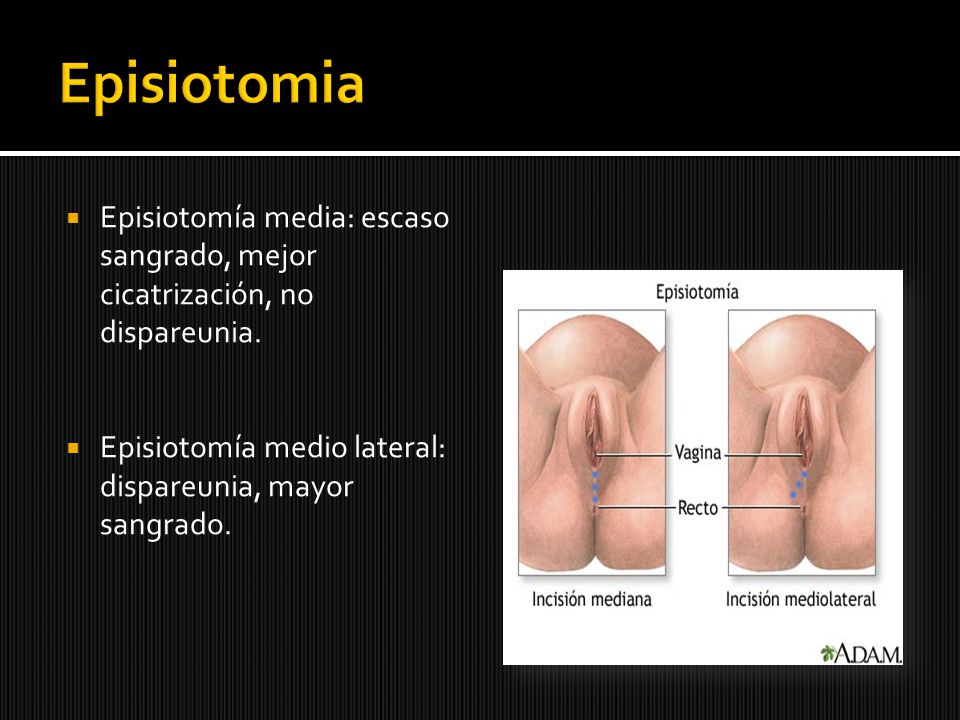 Episiotomia Episiotomía media: escaso sangrado, mejor cicatrización, no dispareunia.