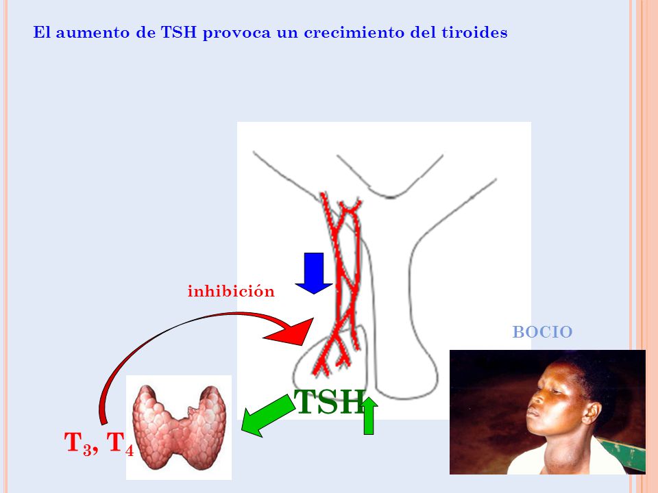 TSH T3, T4 El aumento de TSH provoca un crecimiento del tiroides