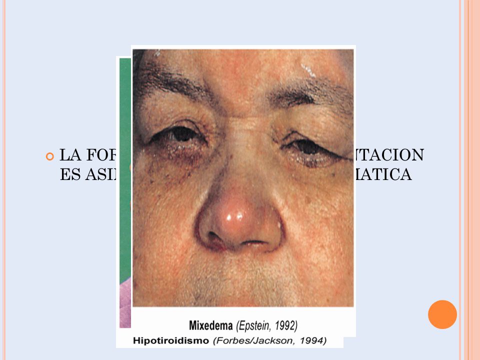 LA FORMA MAS COMUN DE PRESENTACION ES ASINTOMATICA U OLIGOSINTOMATICA