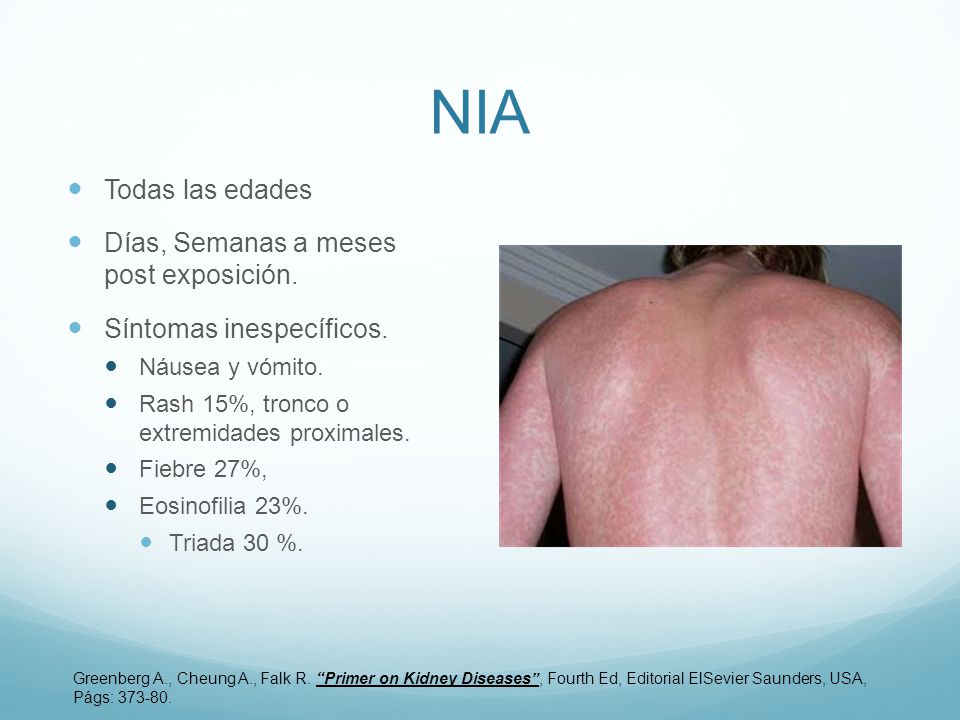 NIA Todas las edades Días, Semanas a meses post exposición.