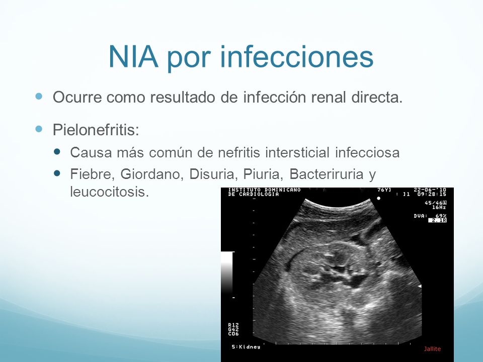 NIA por infecciones Ocurre como resultado de infección renal directa.