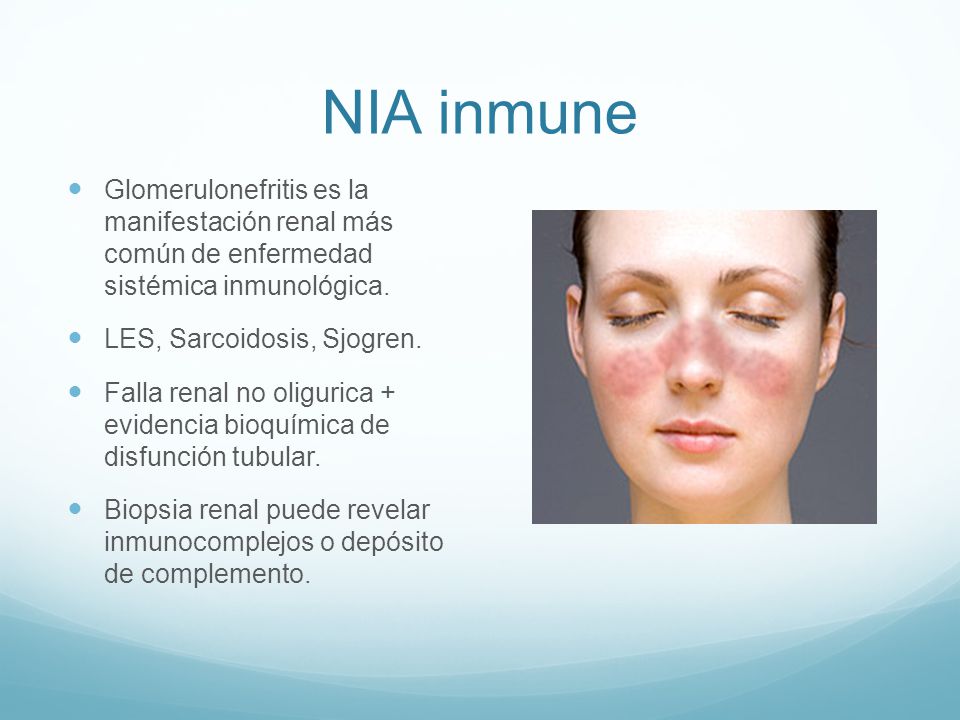 NIA inmune Glomerulonefritis es la manifestación renal más común de enfermedad sistémica inmunológica.
