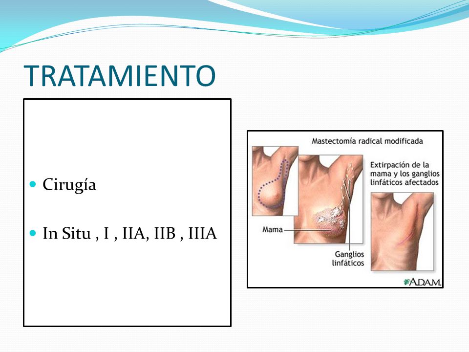 TRATAMIENTO Cirugía In Situ , I , IIA, IIB , IIIA