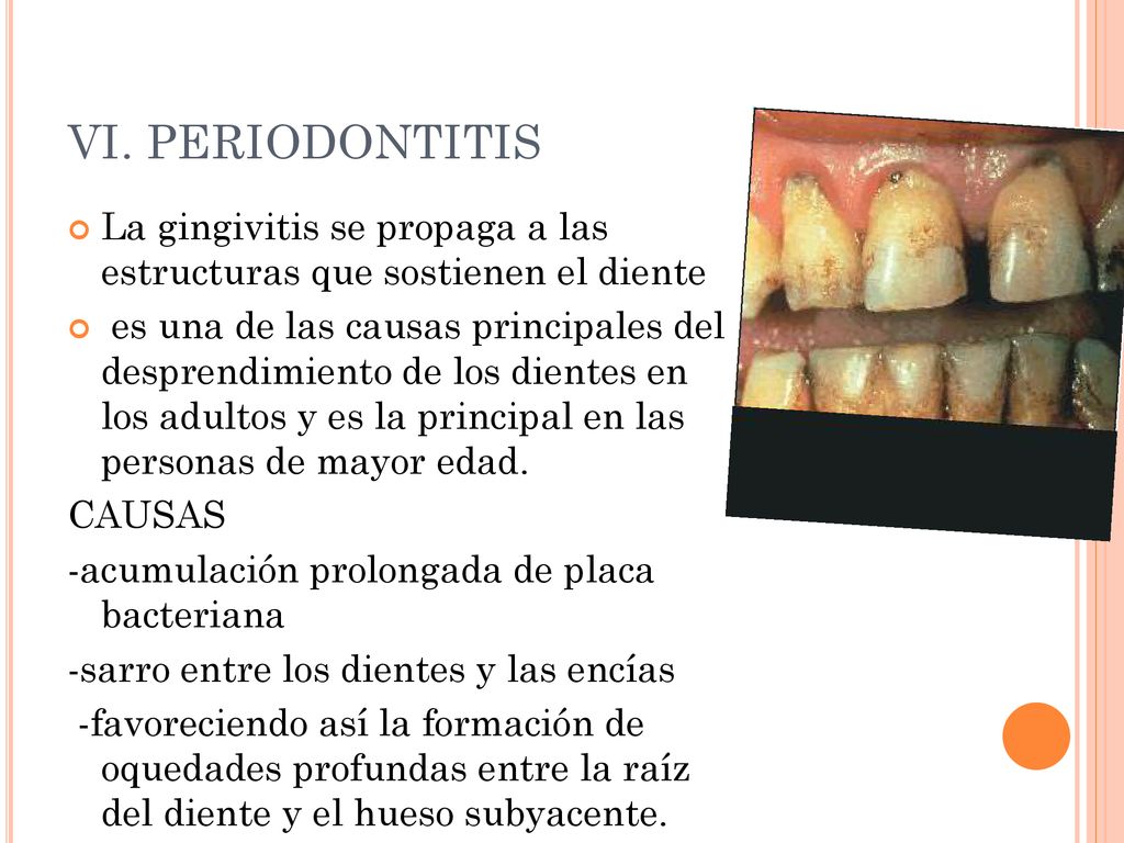 VI. PERIODONTITIS La gingivitis se propaga a las estructuras que sostienen el diente.