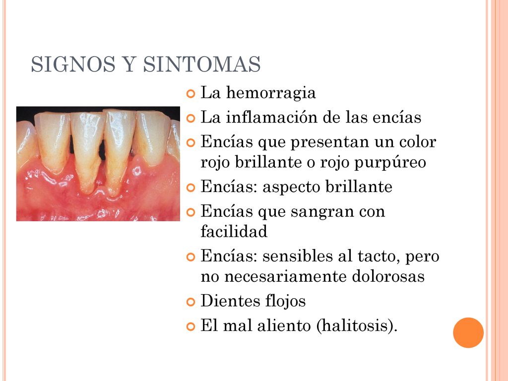 SIGNOS Y SINTOMAS La hemorragia La inflamación de las encías