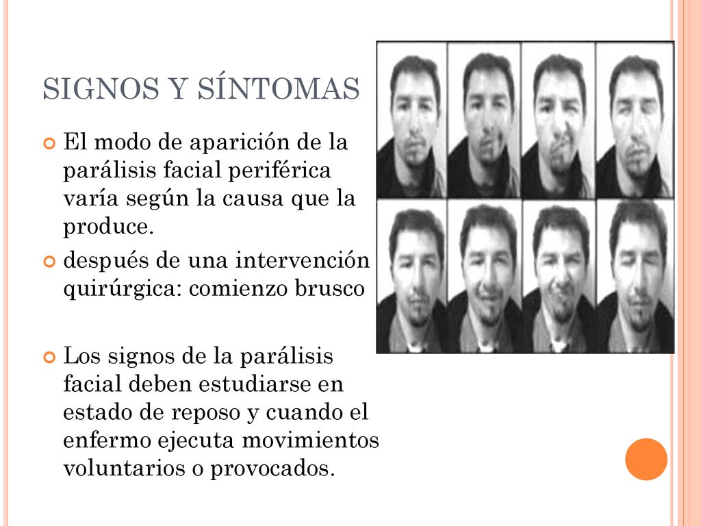 SIGNOS Y SÍNTOMAS El modo de aparición de la parálisis facial periférica varía según la causa que la produce.