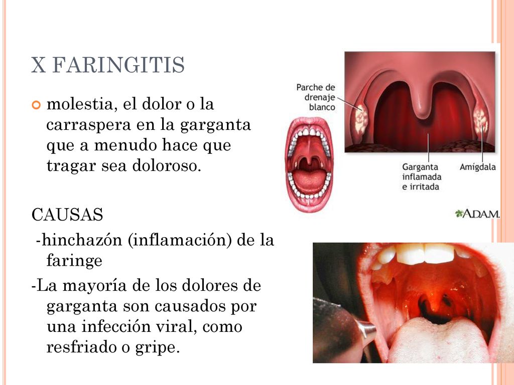 X FARINGITIS molestia, el dolor o la carraspera en la garganta que a menudo hace que tragar sea doloroso.
