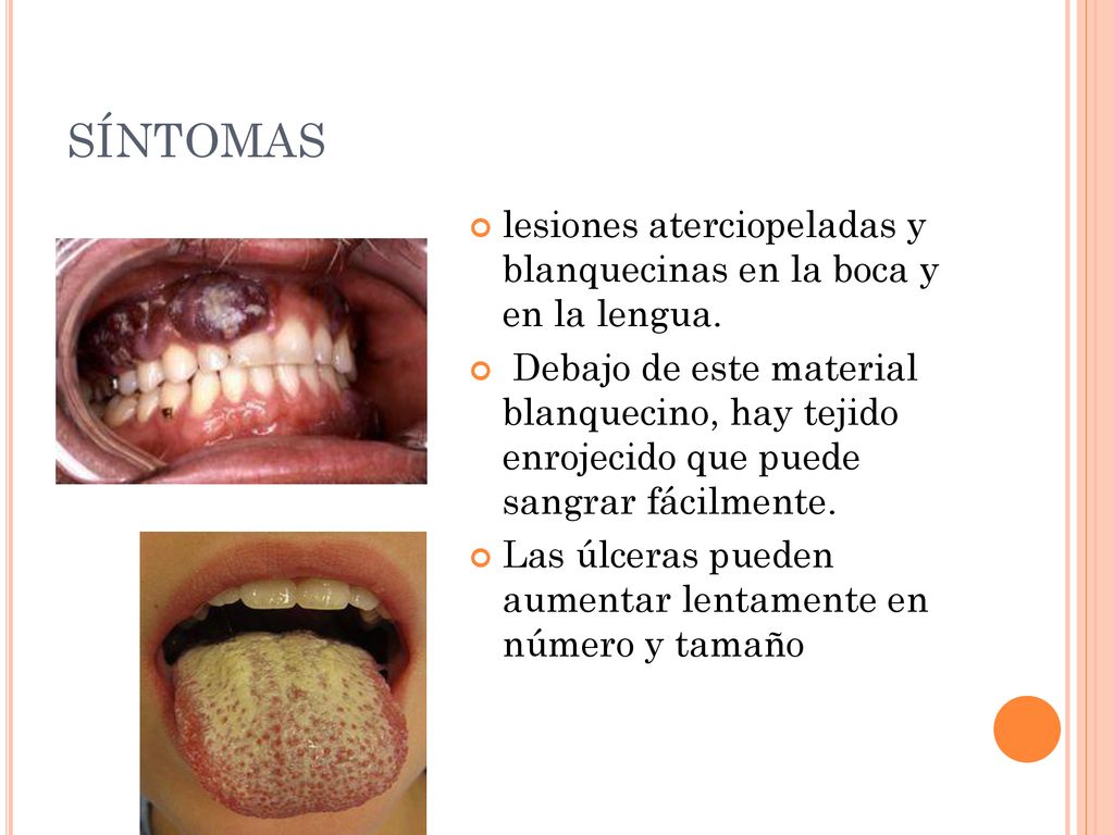 SÍNTOMAS lesiones aterciopeladas y blanquecinas en la boca y en la lengua.