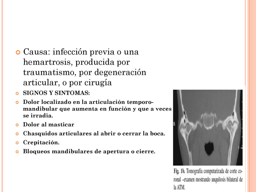 Causa: infección previa o una hemartrosis, producida por traumatismo, por degeneración articular, o por cirugía