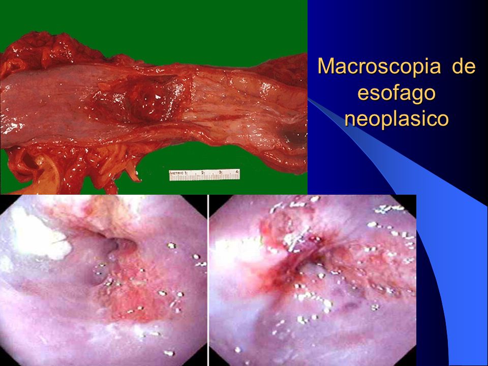 Macroscopia de esofago neoplasico