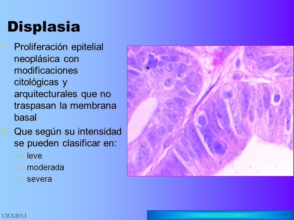 Displasia Proliferación epitelial neoplásica con modificaciones citológicas y arquitecturales que no traspasan la membrana basal.