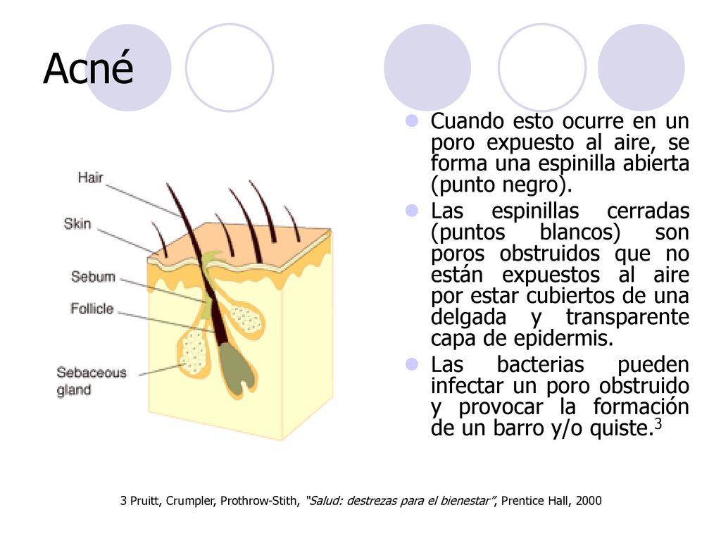 Acné Cuando esto ocurre en un poro expuesto al aire, se forma una espinilla abierta (punto negro).