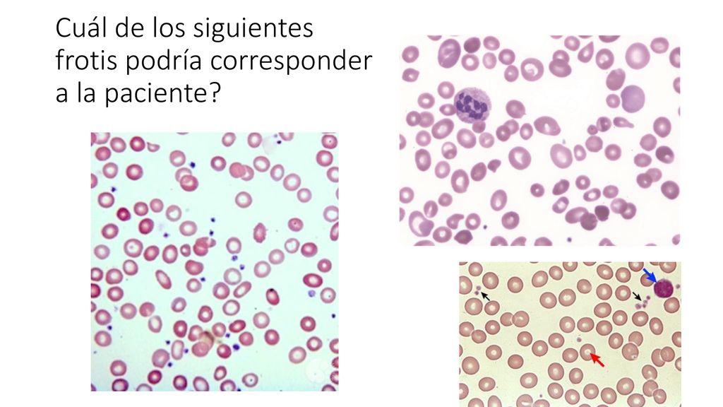 Cuál de los siguientes frotis podría corresponder a la paciente