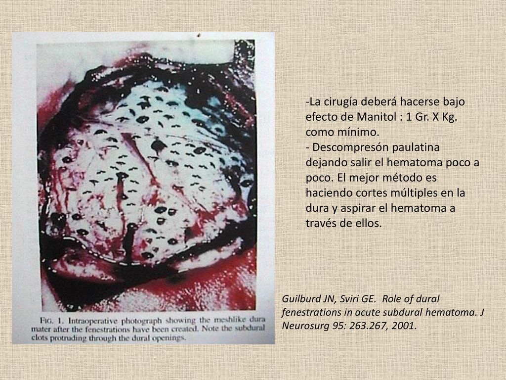 La cirugía deberá hacerse bajo efecto de Manitol : 1 Gr. X Kg